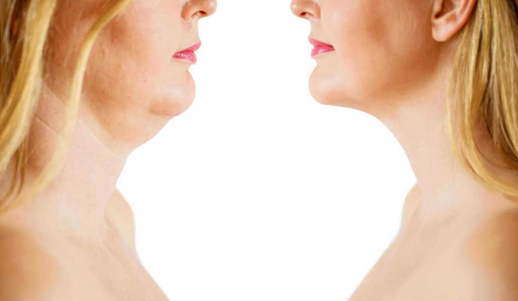 Double Chin treatment Hampton Hill before and after results