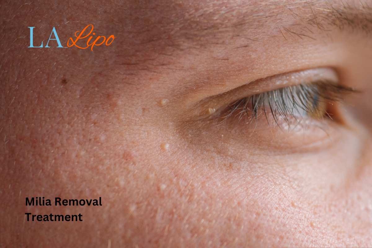 Cryopen Milia Removal: Is It the Easiest and Safest Option Hampton Hill?