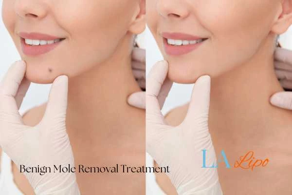 Before-and-after results following benign mole-removal treatment Hampton Hill