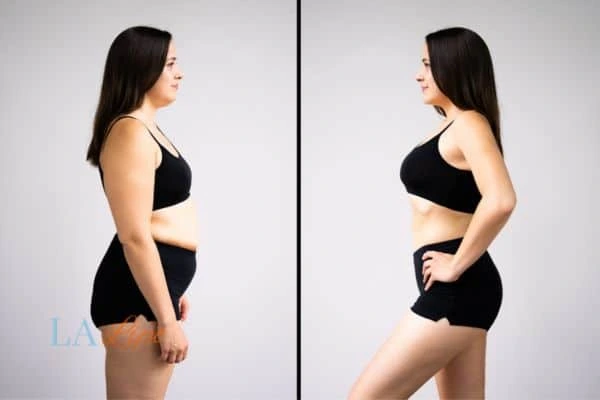 image of woman before and after results of LA-EMS Body Sculpting Hampton Hill to help treat Diastasis recti