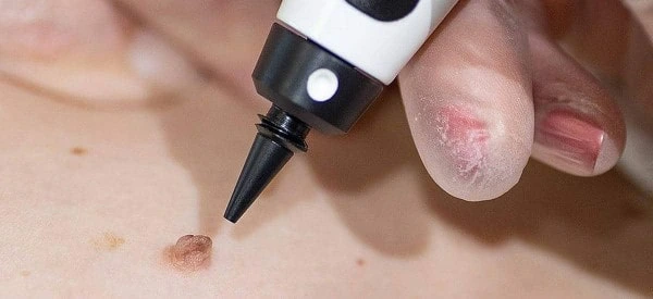 skin tag removal using cryopen Hampton Hill