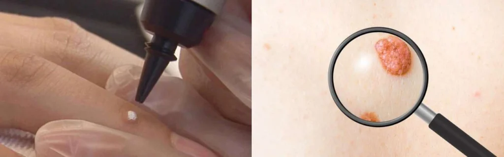 CryoPen practitioner Hampton Hill assessing a benign mole before treatment