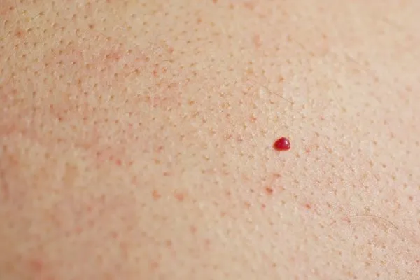 close up of a cherry angioma Hampton Hill