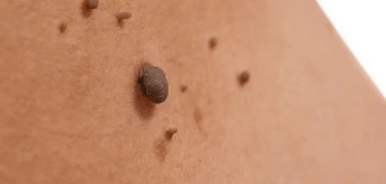 image of a skin tag Hampton Hill