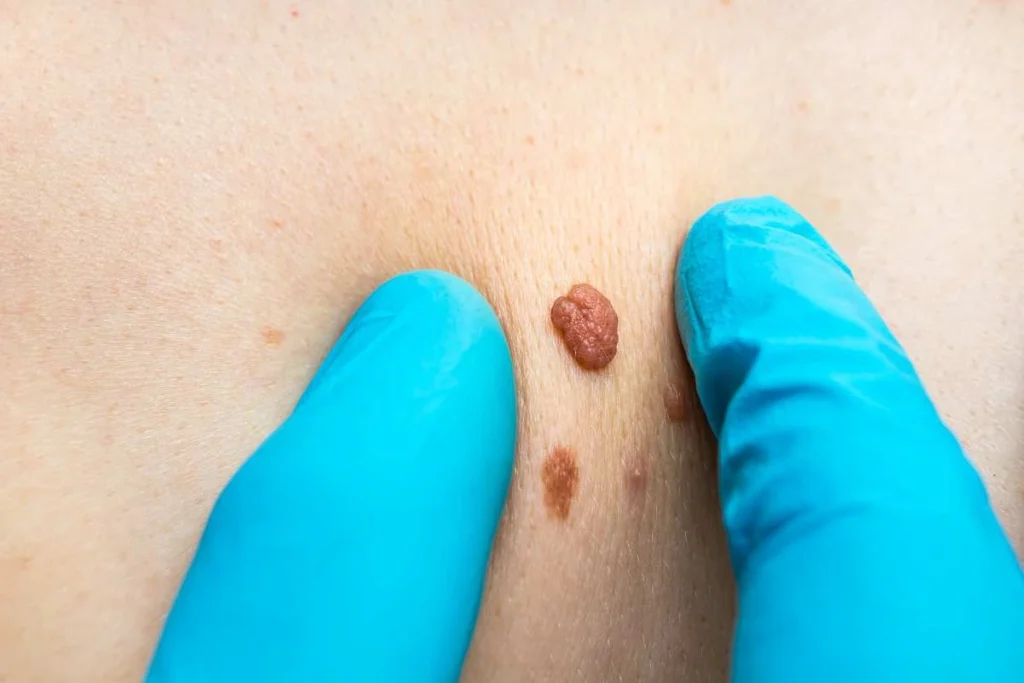 Consultant examining a skin tag Hampton Hill