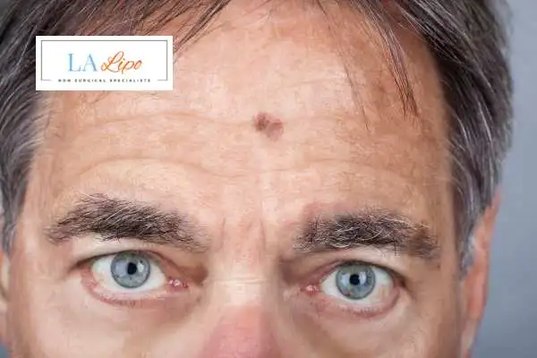 Solar Lentigo Removal Hampton Hill image of man with mark on his forehead
