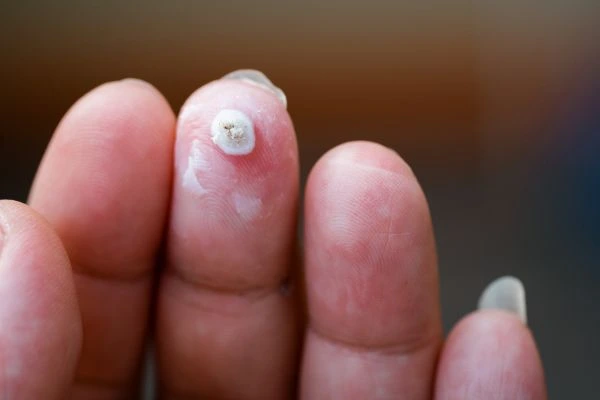 wart on person finger - cryotherapy to treat from LA LIPO Hampton Hill