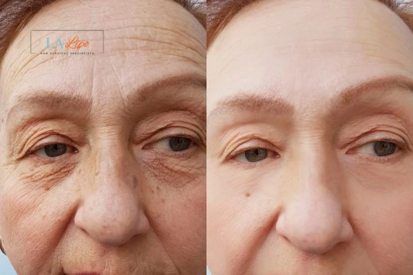 The powerful benefits of Morpheus8 Treatment Hampton Hill - Call Our team today!
