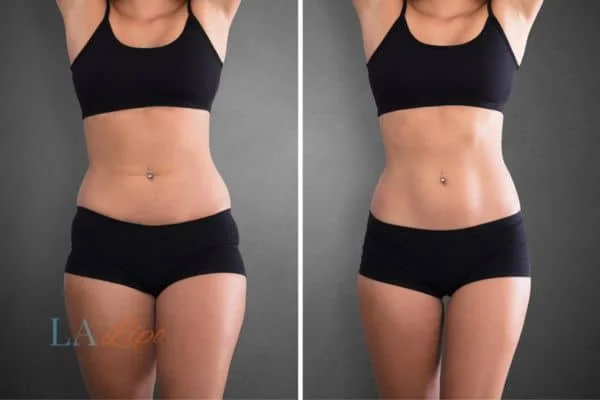 before and after results of non-surgical treatment to help a woman's body image and mental health Hampton Hill