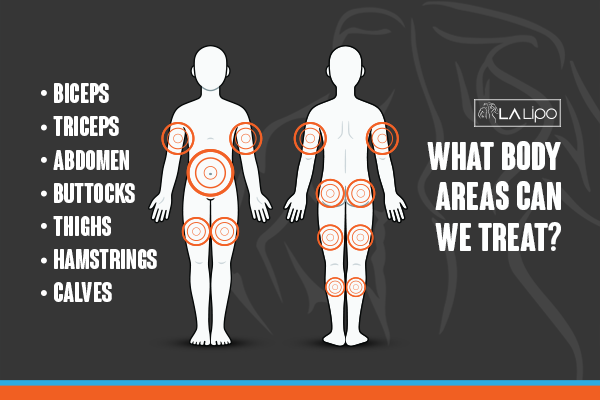 Diagram to show areas you can have LA-EMS Body Sculpting Treatment Hampton Hill