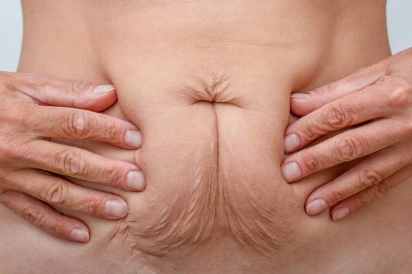Image of a woman's stomach with loose skin - example of skin tightening Hampton Hill options