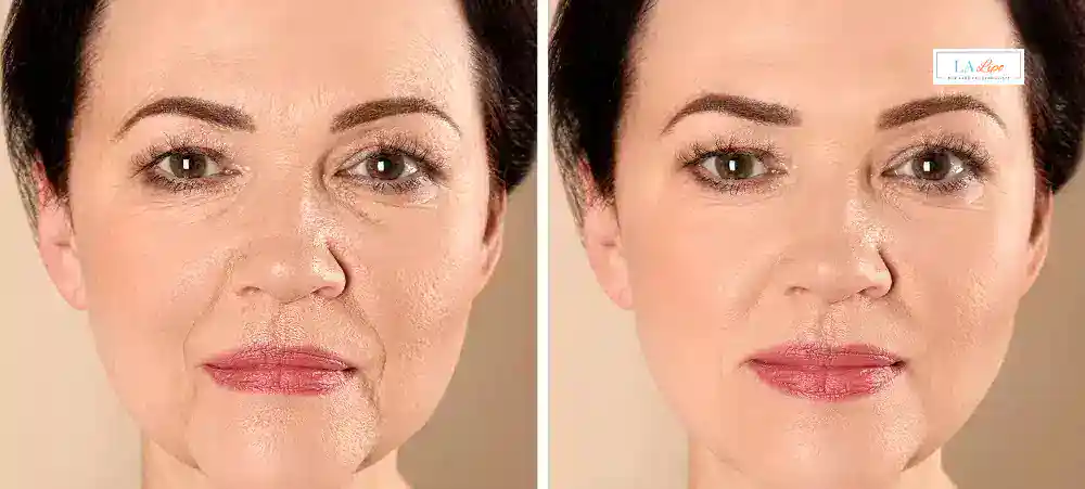 How Long Does It Take to See Results and How Long Do They Last Hampton Hill?