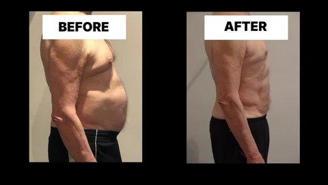 What Symptoms Can Diastasis Recti Cause in Men? Weak Core, Back Pain and Poor Posture Hampton Hill
